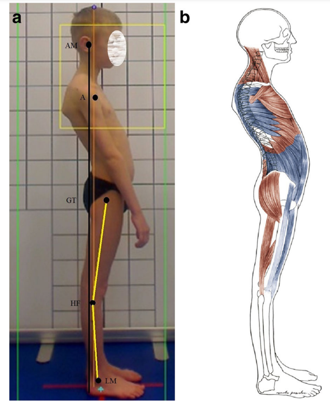 Sway back posture - Rundrücken